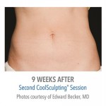 CoolSculpting Before & After Patient #1019