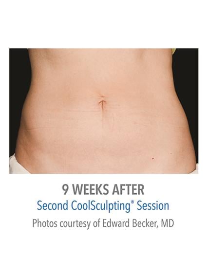 CoolSculpting Before & After Patient #1019
