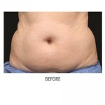 CoolSculpting Before & After Patient #1016