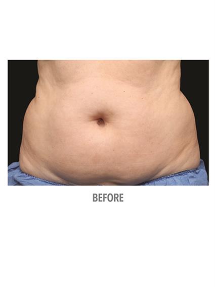 CoolSculpting Before & After Patient #1016