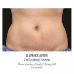 CoolSculpting Before & After Patient #1016