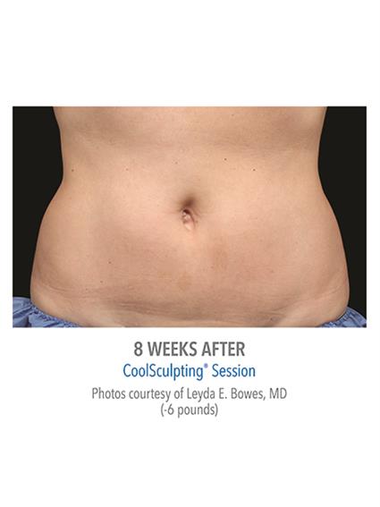 CoolSculpting Before & After Patient #1016