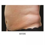 CoolSculpting Before & After Patient #1012