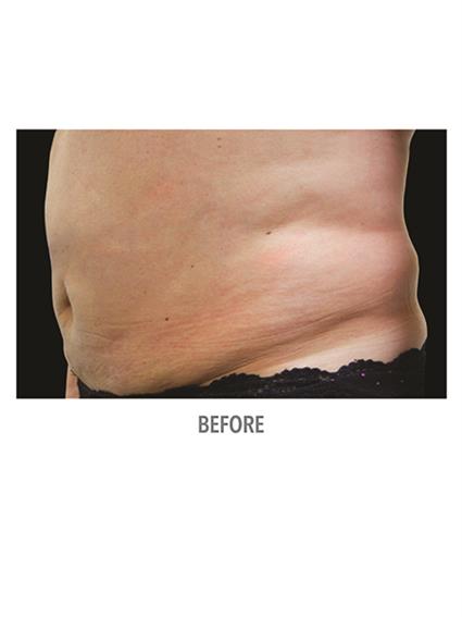 CoolSculpting Before & After Patient #1012