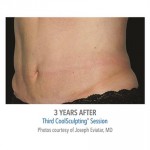 CoolSculpting Before & After Patient #1012