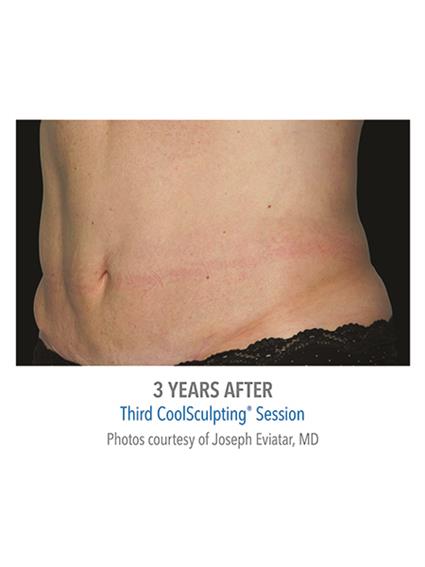 CoolSculpting Before & After Patient #1012