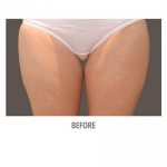 CoolSculpting Before & After Patient #1009