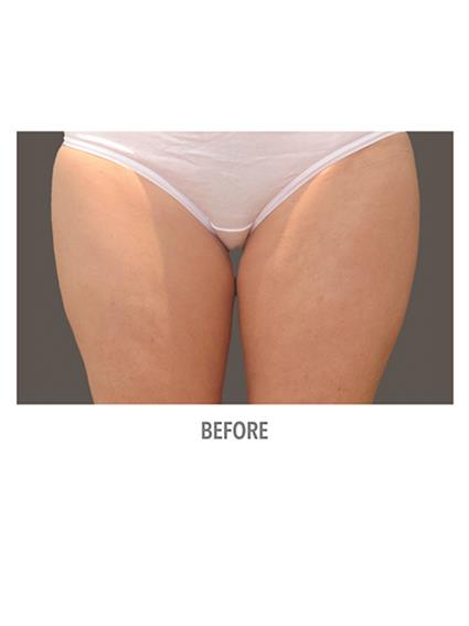 CoolSculpting Before & After Patient #1009