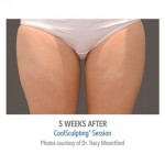 CoolSculpting Before & After Patient #1009