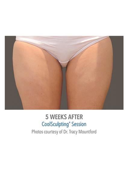 CoolSculpting Before & After Patient #1009