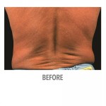 CoolSculpting Before & After Patient #1006