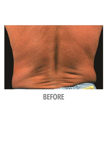 CoolSculpting Before & After Patient #1006