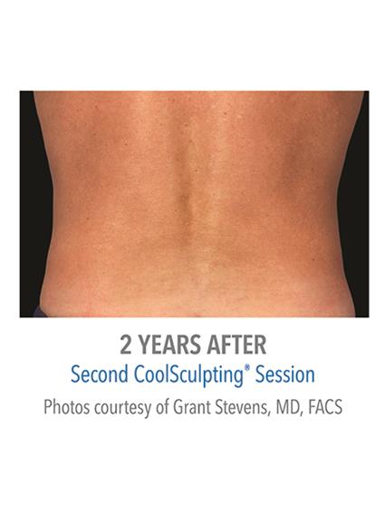 CoolSculpting Before & After Patient #1006