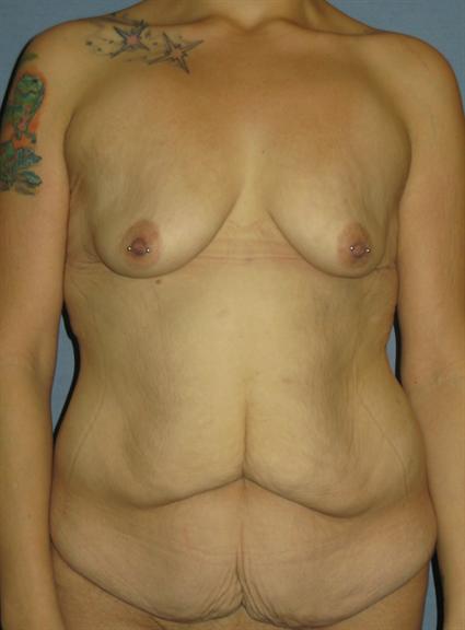 Body Lift Before & After Patient #973