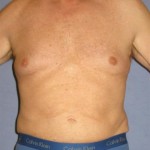 Liposuction Before & After Patient #1053