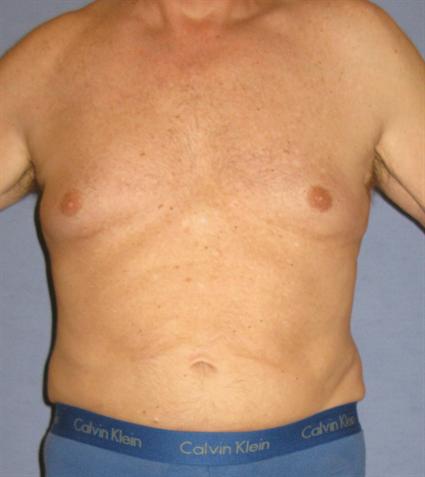 Liposuction Before & After Patient #1053