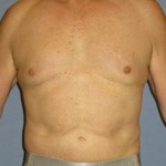 Liposuction Before & After Patient #1053