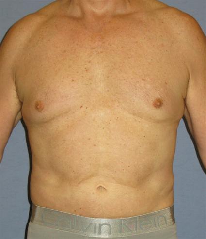 Liposuction Before & After Patient #1053