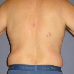 Liposuction Before & After Patient #1053