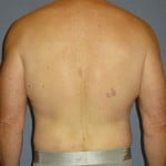 Liposuction Before & After Patient #1053