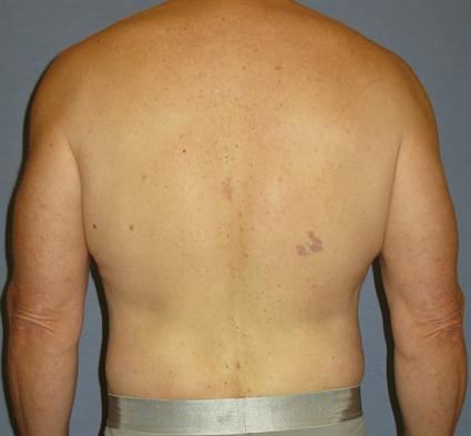 Liposuction Before & After Patient #1053