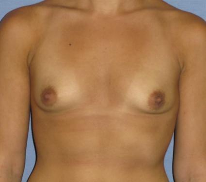 Breast Augmentation Before & After Patient #963