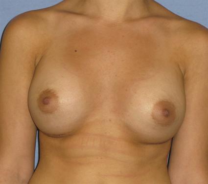 Breast Augmentation Before & After Patient #963