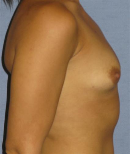 Breast Augmentation Before & After Patient #963