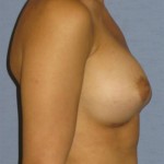 Breast Augmentation Before & After Patient #963