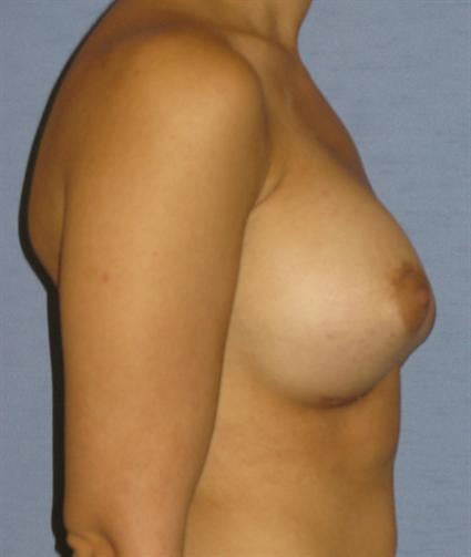 Breast Augmentation Before & After Patient #963