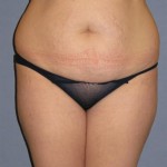 Liposuction Before & After Patient #1046