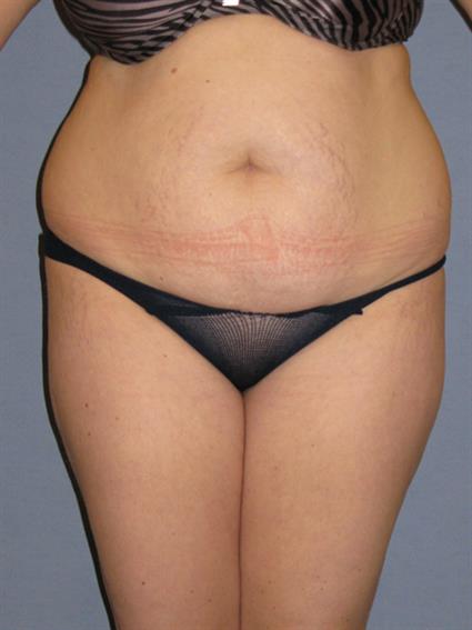 Liposuction Before & After Patient #1046