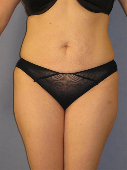 Liposuction Before & After Patient #1046