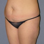 Liposuction Before & After Patient #1046