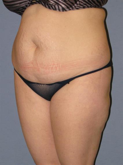 Liposuction Before & After Patient #1046