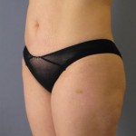 Liposuction Before & After Patient #1046