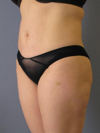 Liposuction Before & After Patient #1046