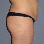 Liposuction Before & After Patient #1046