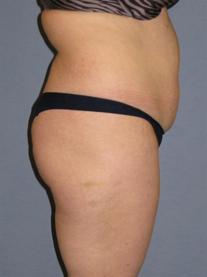 Liposuction Before & After Patient #1046