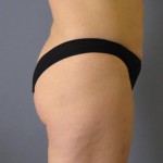 Liposuction Before & After Patient #1046
