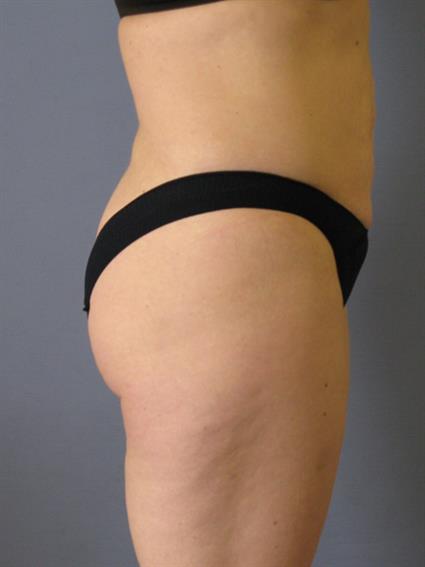 Liposuction Before & After Patient #1046