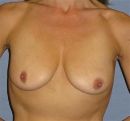 Breast Lift Before & After Patient #1411