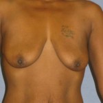 Breast Lift Before & After Patient #1406