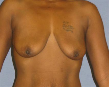 Breast Lift Before & After Patient #1406