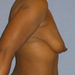 Breast Lift Before & After Patient #1406