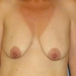 Breast Lift Before & After Patient #1401