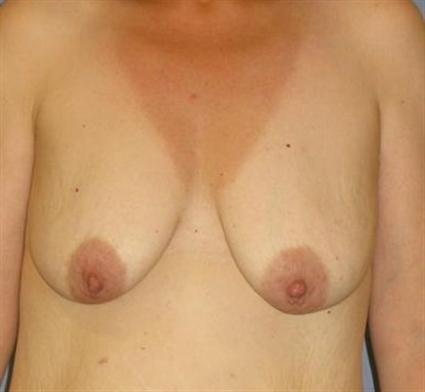 Breast Lift Before & After Patient #1401