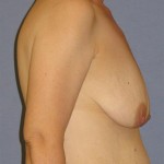 Breast Lift Before & After Patient #1401