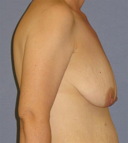 Breast Lift Before & After Patient #1401