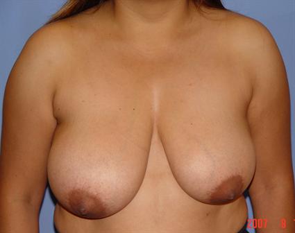 Breast Lift Before & After Patient #1396